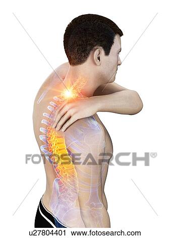 Stock Image - Neck pain, conceptual illustration.. Fotosearch