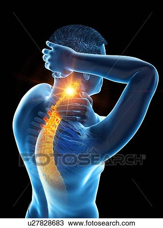 Stock Image - Neck pain, conceptual illustration.. Fotosearch