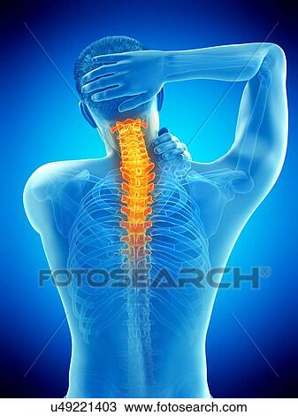 Neck pain, conceptual illustration. View Large Photo Image Stock Image - Neck pain, conceptual illustration.. Fotosearch