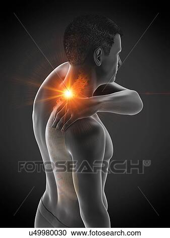 Stock Image - Neck pain, conceptual illustration.. Fotosearch
