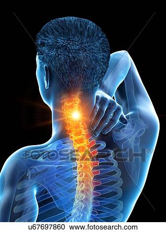 Stock Image - Neck pain, conceptual illustration.. Fotosearch