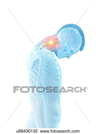 Stock Image - Neck pain, conceptual illustration.. Fotosearch