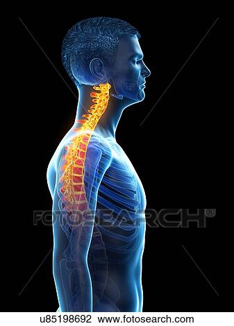 Stock Image - Neck pain, conceptual illustration.. Fotosearch