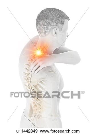 Stock Photo - Neck pain, conceptual illustration.. Fotosearch