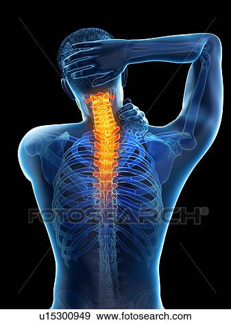 Stock Photo - Neck pain, conceptual illustration.. Fotosearch