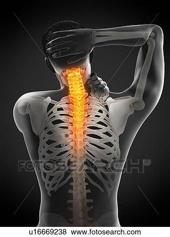 Stock Photo - Neck pain, conceptual illustration.. Fotosearch