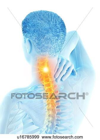 Stock Photo - Neck pain, conceptual illustration.. Fotosearch