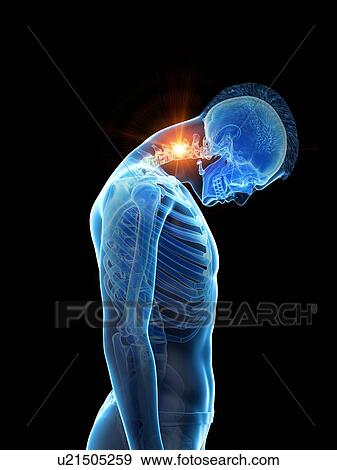 Stock Photo - Neck pain, conceptual illustration.. Fotosearch