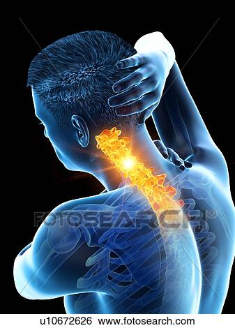 Stock Photograph - Neck pain, conceptual illustration.. Fotosearch