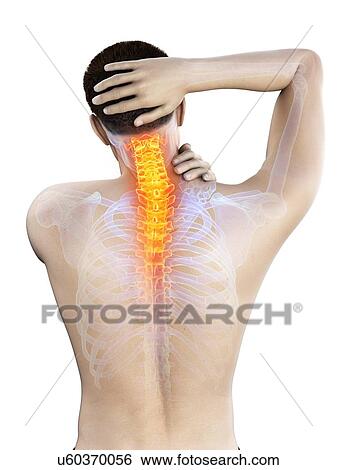 Stock Photograph - Neck pain, conceptual illustration.. Fotosearch