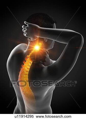 Stock Photography - Neck pain, conceptual illustration.. Fotosearch