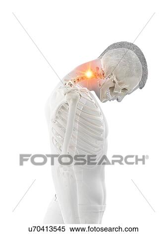 Stock Photography - Neck pain, conceptual illustration.. Fotosearch