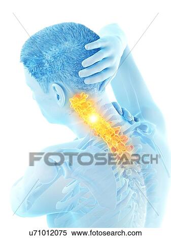 Stock Photography - Neck pain, conceptual illustration.. Fotosearch