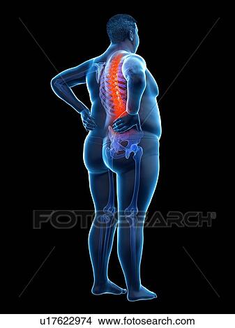 Picture - Obese man with back pain, computer illustration.. Fotosearch
