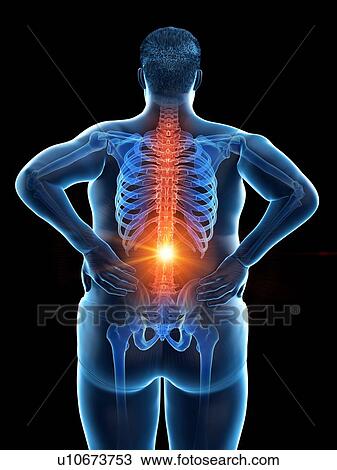 Stock Image - Obese man with back pain, computer illustration.. Fotosearch