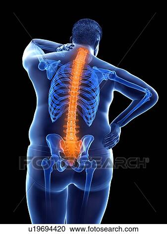 Stock Image - Obese man with back pain, computer illustration.. Fotosearch