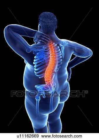 Stock Photo - Obese man with back pain, computer illustration.. Fotosearch