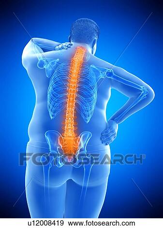 Stock Photo - Obese man with back pain, computer illustration.. Fotosearch