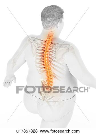 Stock Photo - Obese man with back pain, computer illustration.. Fotosearch
