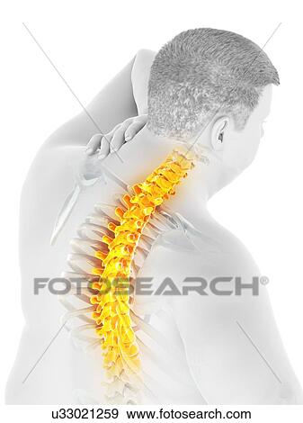 Stock Photo - Obese man with back pain, computer illustration.. Fotosearch