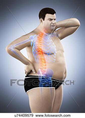 Stock Photo - Obese man with back pain, computer illustration.. Fotosearch