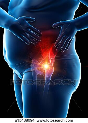 Picture - Obese man with hip pain, computer illustration.. Fotosearch
