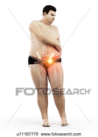 Obese man with hip pain, computer illustration. View Large Photo Image Stock Image - Obese man with hip pain, computer illustration.. Fotosearch