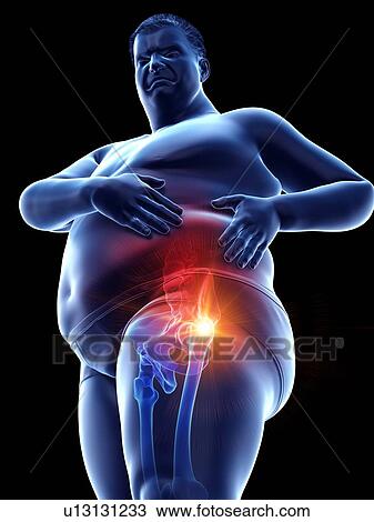 Stock Image - Obese man with hip pain, computer illustration.. Fotosearch