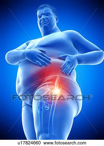 Stock Image - Obese man with hip pain, computer illustration.. Fotosearch