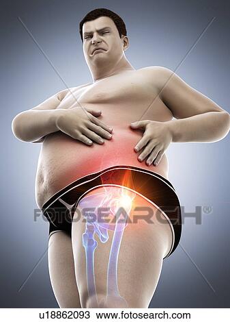 Stock Image - Obese man with hip pain, computer illustration.. Fotosearch