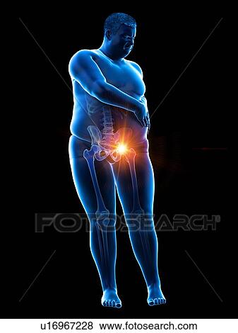 Stock Photo - Obese man with hip pain, computer illustration.. Fotosearch