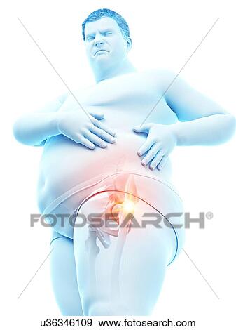 Stock Photo - Obese man with hip pain, computer illustration.. Fotosearch