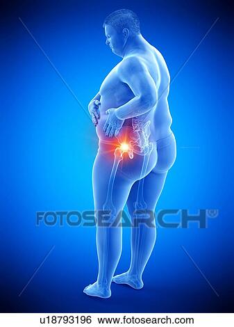 Stock Photograph - Obese man with hip pain, computer illustration.. Fotosearch