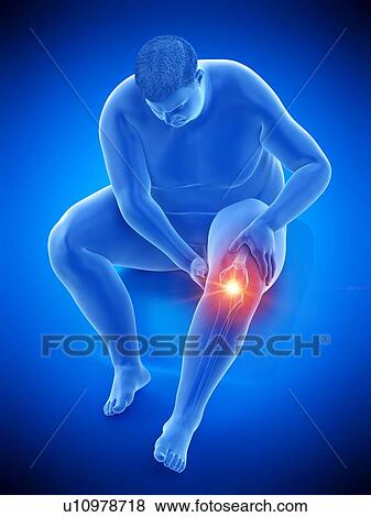 Stock Photo - Obese man with knee pain, computer illustration.. Fotosearch