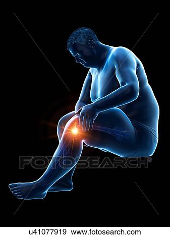 Stock Photo - Obese man with knee pain, computer illustration.. Fotosearch