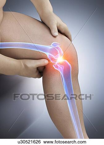 Stock Photograph - Obese man with knee pain, computer illustration.. Fotosearch