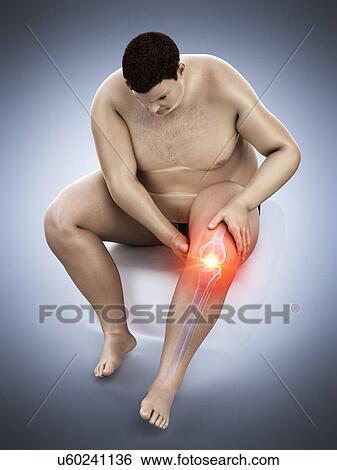 Stock Photograph - Obese man with knee pain, computer illustration.. Fotosearch