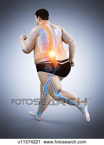 Stock Image - Obese runner with back pain, computer illustration.. Fotosearch