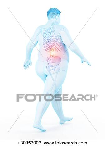 Stock Image - Obese runner with back pain, computer illustration.. Fotosearch