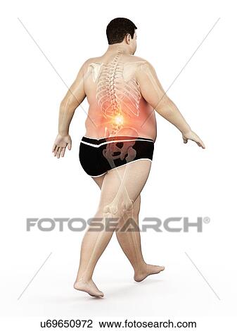 Stock Image - Obese runner with back pain, computer illustration.. Fotosearch