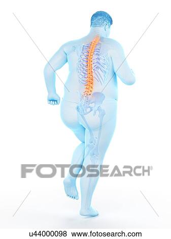 Stock Photo - Obese runner with back pain, computer illustration.. Fotosearch