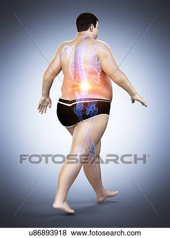 Stock Photo - Obese runner with back pain, computer illustration.. Fotosearch