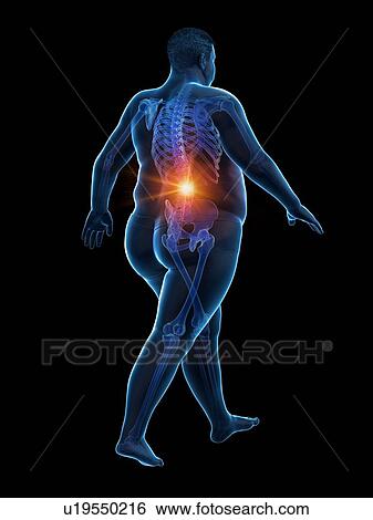 Stock Photograph - Obese runner with back pain, computer illustration.. Fotosearch