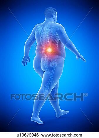 Stock Photograph - Obese runner with back pain, computer illustration.. Fotosearch