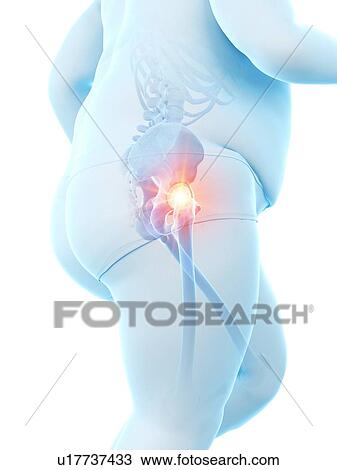 Stock Image - Obese runner with hip pain, computer illustration.. Fotosearch