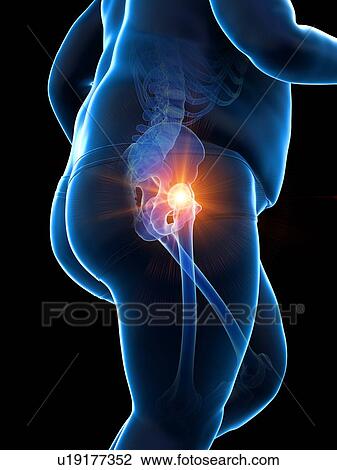 Stock Image - Obese runner with hip pain, computer illustration.. Fotosearch