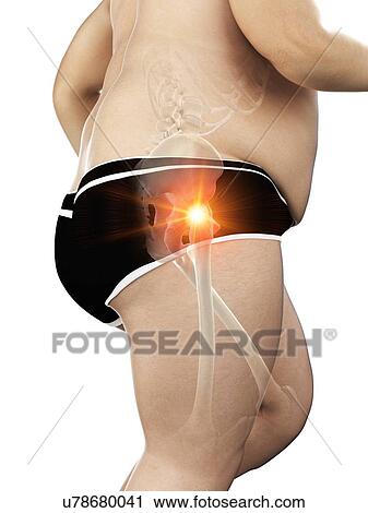 Stock Image - Obese runner with hip pain, computer illustration.. Fotosearch