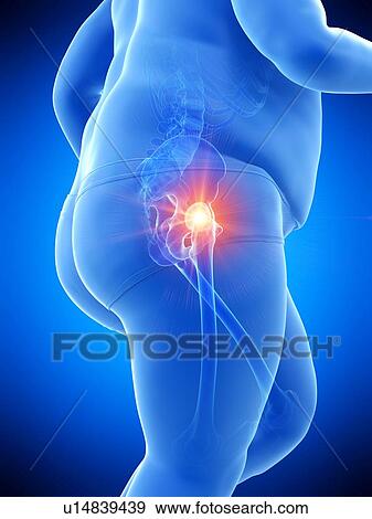 Stock Photo - Obese runner with hip pain, computer illustration.. Fotosearch