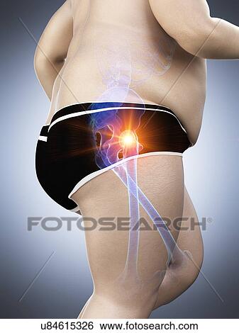 Stock Photograph - Obese runner with hip pain, computer illustration.. Fotosearch