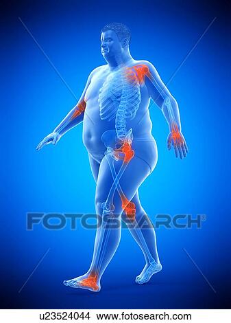 Picture - Obese runner with joint pain, computer illustration.. Fotosearch